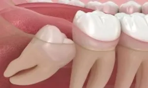 Vì sao một số người không mọc răng khôn? Vì sao một số người không mọc răng khôn?